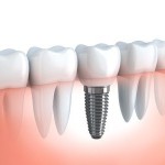 are-dental-implants-right-for-me2-150x150